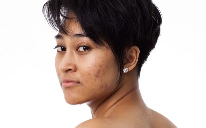 Wondering how to get rid of acne can persist into adulthood.