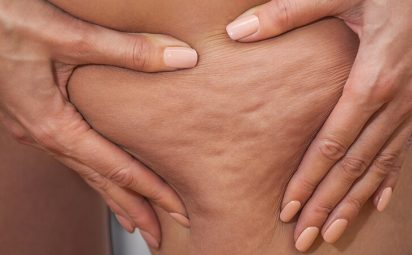 Cellulite is something that nearly all women have, but if you’re feeling self-conscious about your cellulite, you definitely aren’t alone.