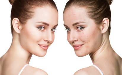 woman before and after with faded acne scars