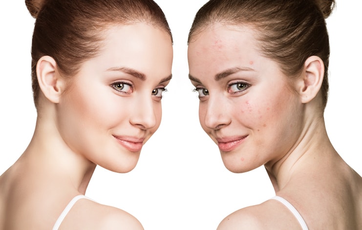 woman before and after with faded acne scars