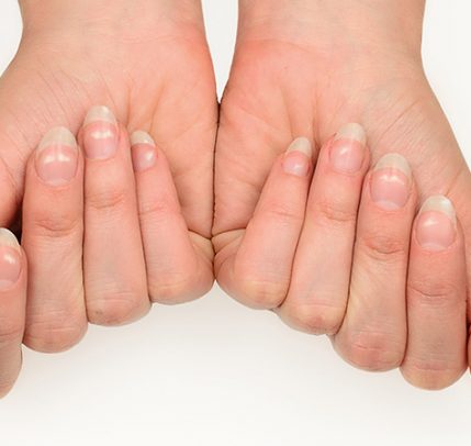woman with fingers bent inwards showing white spots on her nails