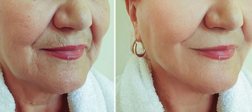 how to remove wrinkles from face quickly